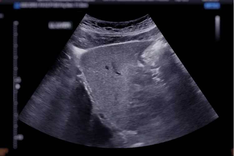 Ultrasound image of a patient’s liver as part of a liver elastography procedure to assess liver stiffness.