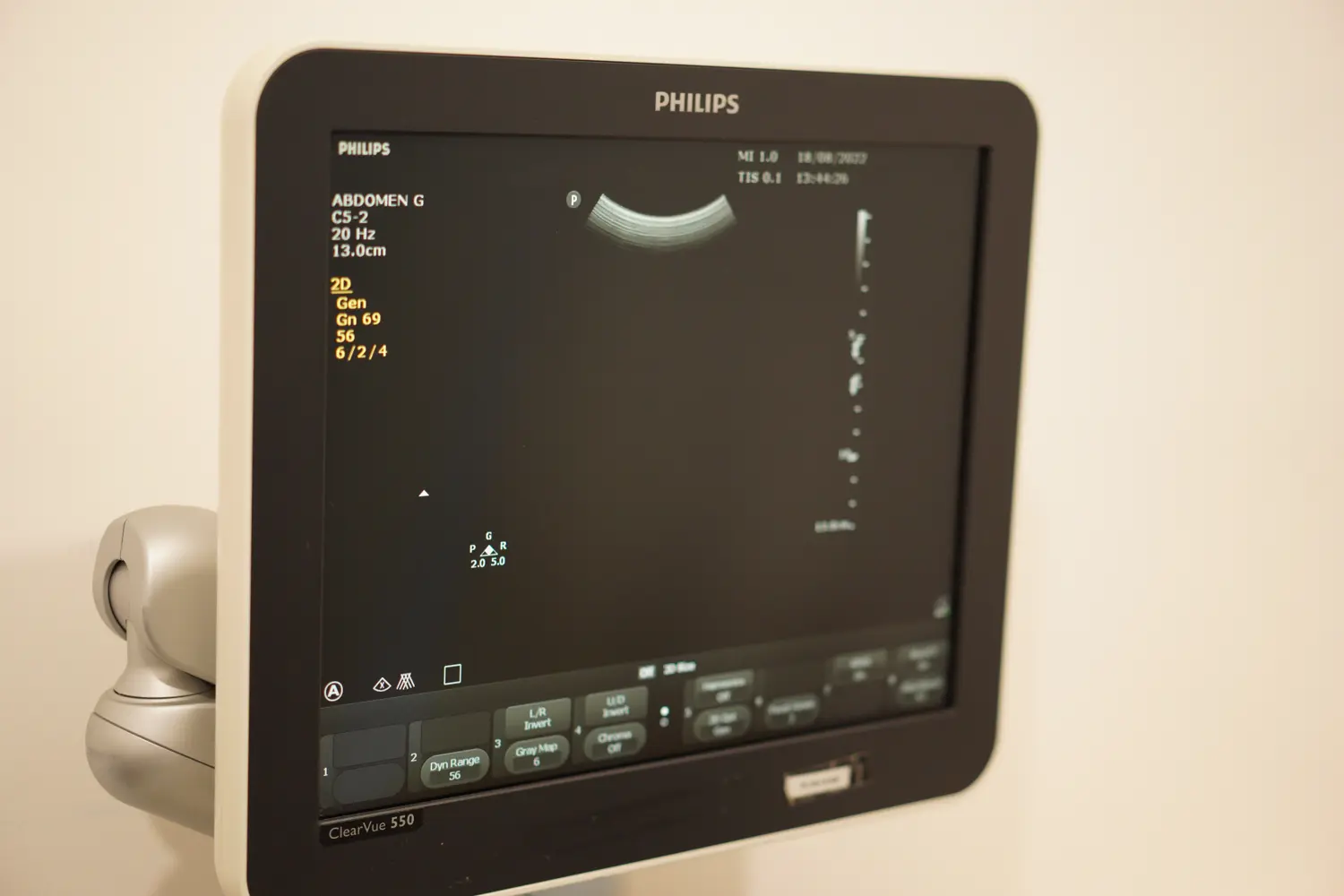 Screen of ultrasound machine showing patient undergoing ultrasound scan