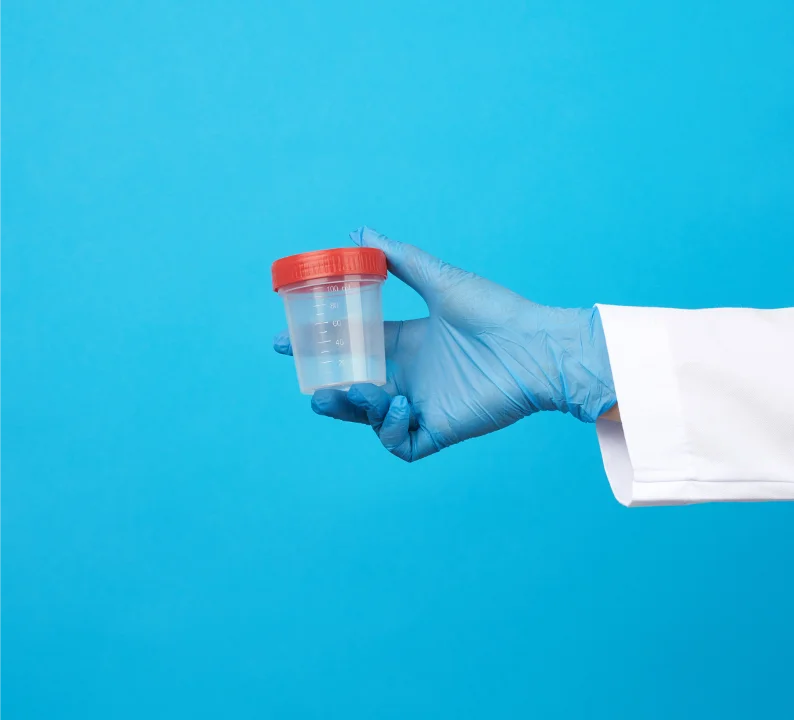 Urine sample container for urine culture test.