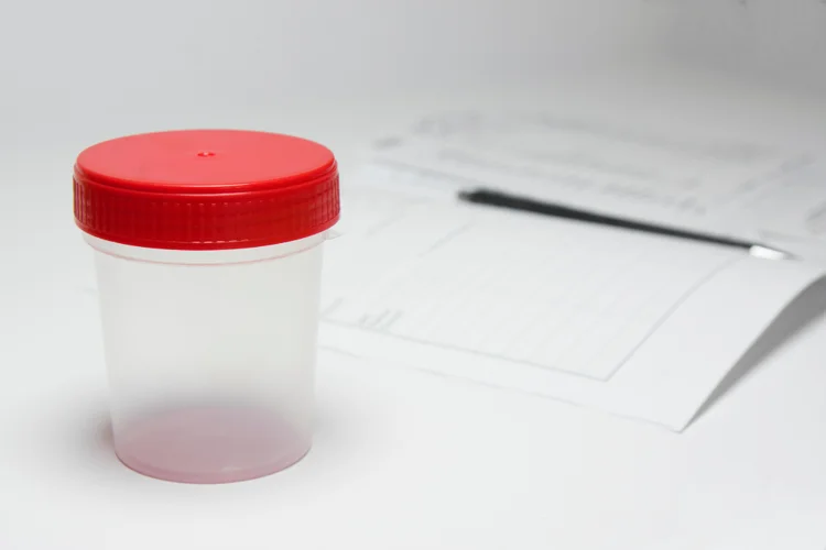 Urine sample container on a medical form, representing a urinary aluminium test for assessing recent aluminium exposure levels.