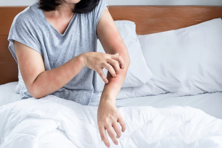 Woman sitting on bed scratching eczema flare-up caused by dust mite allergy, with white bedding and wooden headboard in the background.